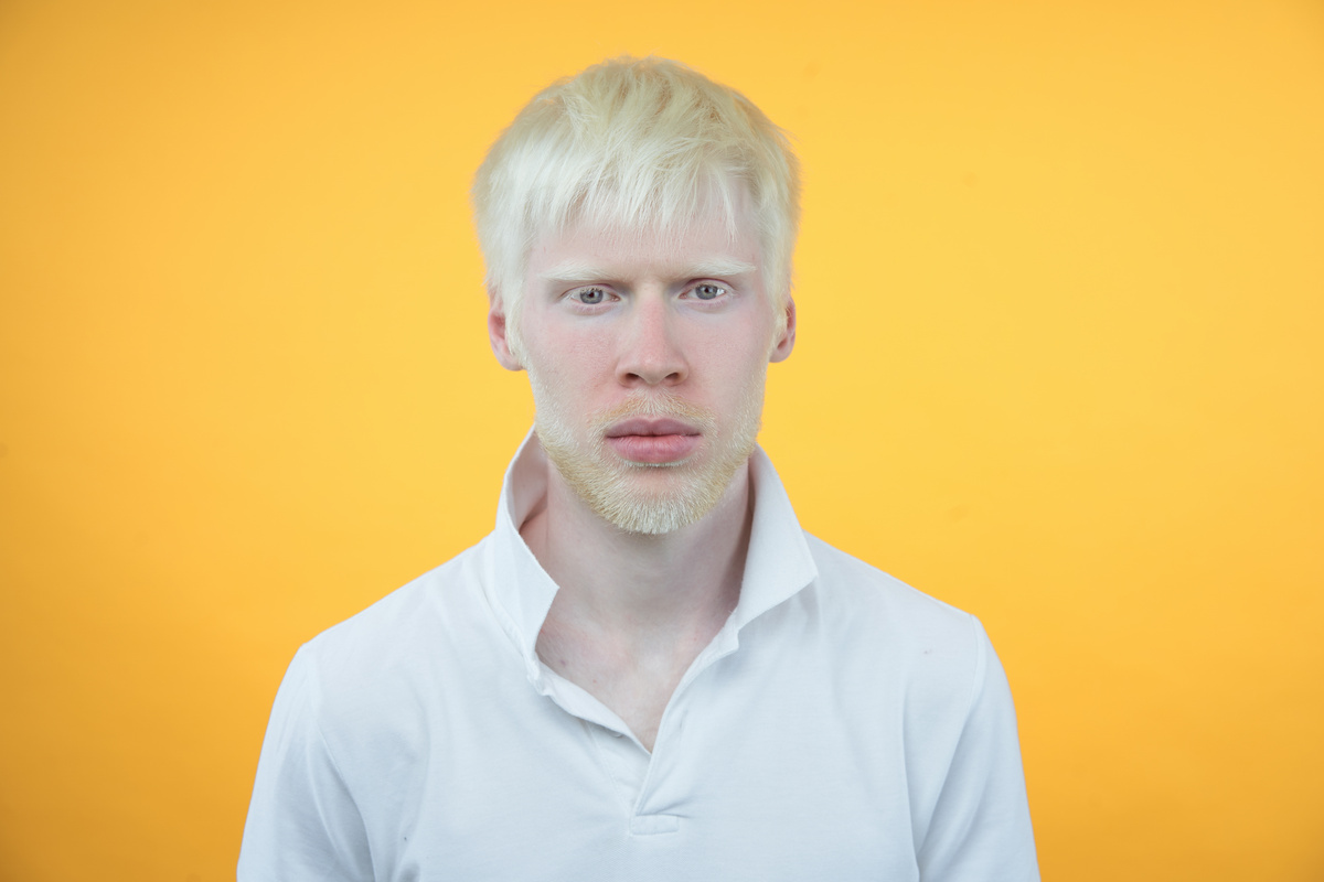 Portrait of a Man with Albinism